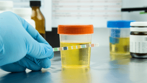 Lab technician holding a urine test strip next to a specimen cup to detect ETG alcohol metabolites in urine